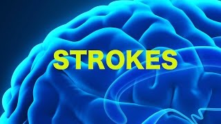 Strokes amp The Rule of 4s  USMLE [upl. by Adnawat]