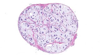 Mucinous carcinoma of skin  BEST EXAMPLE EVER AIP France 2021  Bonus case dermpath pathology [upl. by Neidhardt]