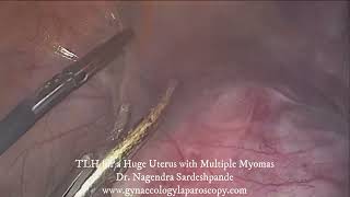 TLH for a huge uterus with multiple myomas [upl. by Adan]