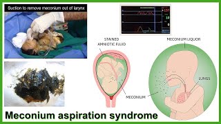 Meconium aspiration syndrome updates [upl. by Marty]