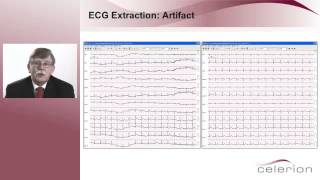 Highly Automated ECG Analyses [upl. by Asatan234]