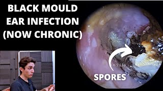 Black Mould Infection Is Now Chronic Otomycosis [upl. by Letnuahc]