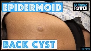 An Epidermoid Cyst Lets cure it with a curette [upl. by Yrffoeg]