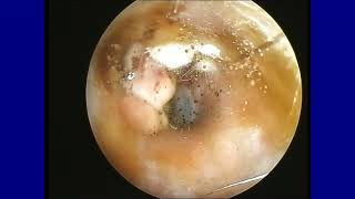 Fungal Ear Infection [upl. by Berwick]