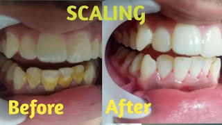 Scaling procedure Tartar removal [upl. by Leahey17]