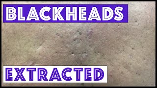 Were these blackheads amp cysts from Agent Orange exposure [upl. by Llerdnam798]