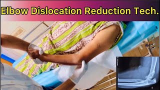 Elbow Dislocation Reduction How to Reduce Posterior Dislocation Elbow with patient in Supine positn [upl. by Ahsitahs]