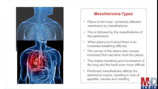 MesotheliomaA Rare Lung Cancer [upl. by Skantze462]