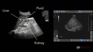 Point of Care Ultrasound for Ascites POCUS [upl. by Drucie]