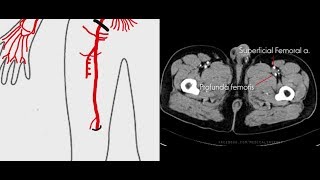 Arteries of Lower Limb  CT anatomy [upl. by Lance]