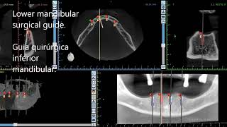 Lower edentulous surgical guide Guía quirúrgica desdentado inferior [upl. by Oconnor]