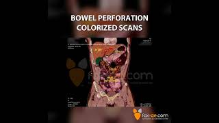 Bowel Perforation Colorized Scan [upl. by Zared]