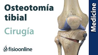 OSTEOTOMÍA TIBIAL Técnica de la artrosis de rodilla sin prótesis [upl. by Gav]