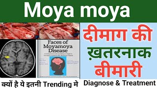 moyamoya disease in hindi  Diagnose amp treatment  moyamoya disease  moye moye song Drx Rabbani [upl. by Corri76]