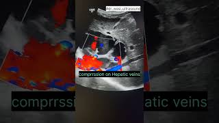 Hepatic cyst livercyst hepatuccyst ultrasonography [upl. by Tara653]