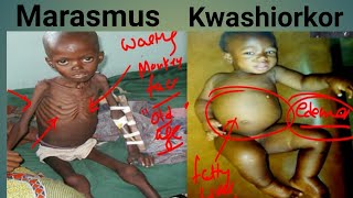 Protein Energy Malnutrition Biochemistry  Marasmus Vs Kwashiorkor  Kwashiorkor  Marasmus [upl. by Yror856]