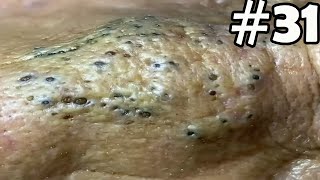 quot🔴 Satisfying Pimple Popping Extravaganza Watch the Most Satisfying Pops Everquot 31 [upl. by Yrelle19]