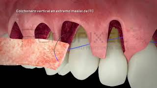 Múltiples recesiones gingivales adyacentes Dr Ion Zabalegui  PerioPixel [upl. by Aitan]