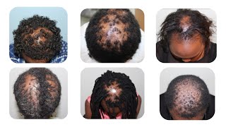 CCCA hair loss treatment [upl. by Hnid628]