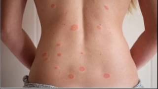 Pityriasis Rosea [upl. by Lorenzo501]