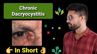 Chronic Dacryocystitis lecture opthalmology in short [upl. by Haisej]