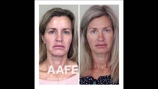 Submental Chin Tightening and Fat Removal with VSoft Lift Smooth PDO Threads [upl. by Liauqram]