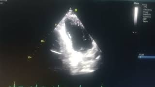 akinetic septum hypokinetic mid apical anterior and inferior wall moderate Lv [upl. by Crabb373]