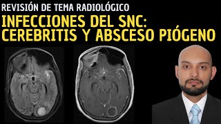 Revisión de Tema 81 Infecciones del sistema nervioso central Cerebritis y absceso piógeno [upl. by Aloke]