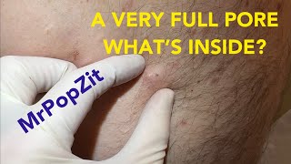 Very full pore Let’s see what’s inside Do you think it’s just a clogged pore or is there a sac [upl. by Ayalahs]