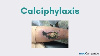 Calciphylaxis CUA [upl. by Aerdnat]