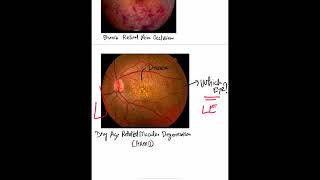 How to identify which eye based on fundus photo Basics Shorts [upl. by Ayila]