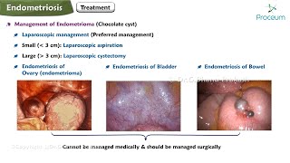 Endometriosis Etiology Pathology Clinical features Investigations Treatment [upl. by Duaner408]