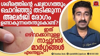 ശരീരത്തിൽ ചൊറിഞ്ഞു തടിക്കുന്ന അലർജി ഉണ്ടാകുന്നതെങ്ങനെ ചൊറിച്ചിലും അലർജിയ്ക്കും നാച്ചുറൽ മാർഗ്ഗങ്ങൾ [upl. by Araek]