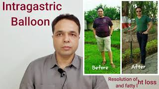 Weight Loss Success Stories with Gastric BalloonSafeEffectiveNon Surgical Weight Loss Procedure [upl. by Eirellam]