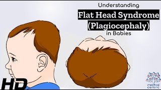 Flat Head Syndrome Explained Causes Symptoms and Solutions [upl. by Eibob]