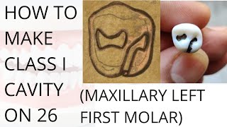 Class 1 Cavity Preparation on 26 with Palatal Ext Max left first Molar Heart and Kidney shaped [upl. by Nagear]