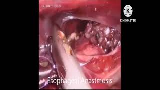 Thoracoscopic repair of Esophageal atresia with tracheoesophageal fistula [upl. by Muirhead]