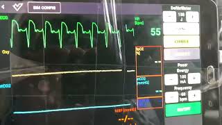 QRS Asystolic Beats [upl. by Starinsky]