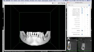 Dental3DPlugin 310  CBCT 3D Surface fast clipping [upl. by Welcome406]