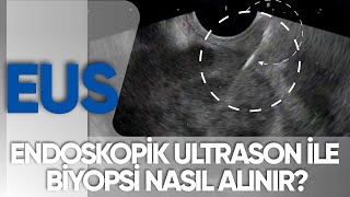 Endoskopik Ultrason EUS ile biyopsi alımı  ProfDr Yusuf AKCAN [upl. by Harvison]