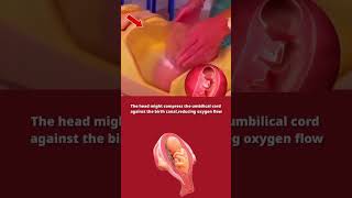 Breech baby complications DrPoonam Maggo shorts breechbaby shortsvideo [upl. by Neville]