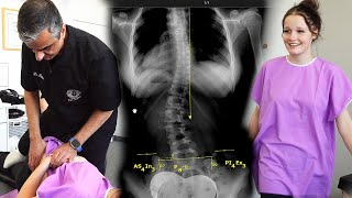 Scoliosis Evaluation For A Back Brace Headaches amp Back Pain Helped ​ Part 4 [upl. by Aek]