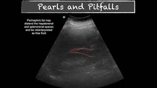 POCUS  E FAST  Pitfalls [upl. by Nesilla367]