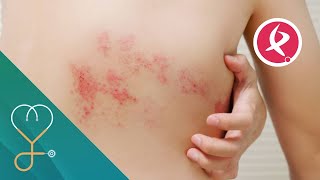 Herpes Zóster ¿quién debe vacunarse  A Nuestra salud [upl. by Puklich]