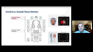 Tissue oximetry StO2 monitoring in the ECMO patient [upl. by Colet]