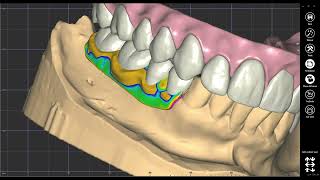 Milled ivotion denture teeth design on the frame [upl. by Aifas]