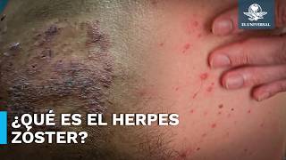 Al menos 30 de las personas que padecieron varicela tendrán herpes zoster en algún momento [upl. by Broderick]