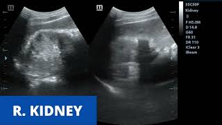 Acute Pyelonephritis  Ultrasound Case [upl. by Ilbert]