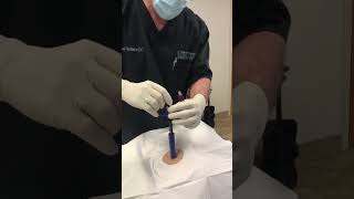 Bone Marrow Aspiration Technique with Marrow Cellution [upl. by Esilahc741]