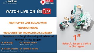 VIDEO ASSISTED THORACOSCOIC SURGERY FOR RIGHT UPPER LOBE BULLAE WITH PNEUMOTHORAX [upl. by Atihcnoc]